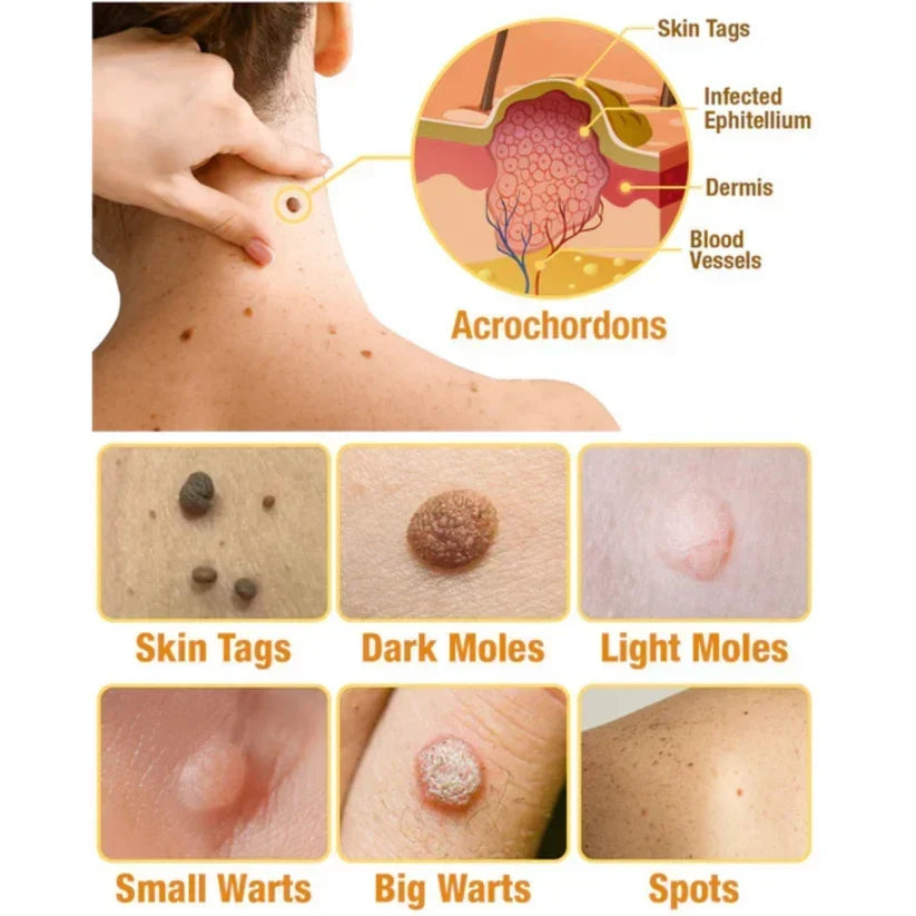 Skin Tag Removal Spray with Natural Bee Venom Extract for At-Home Treatment of Tags, Warts & Moles