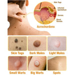 Skin Tag Removal Spray with Natural Bee Venom Extract for At-Home Treatment of Tags, Warts & Moles