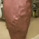 Leg Vein Spray Circulation-Boosting Swelling Relief