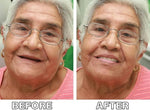 Silicone Dental Prosthetics for Comfortable, Natural Look